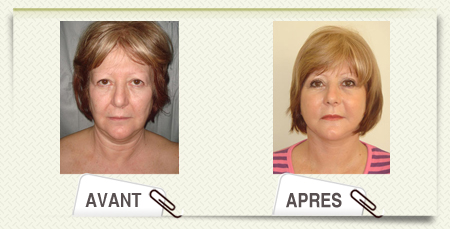 lifting cervico facial photos