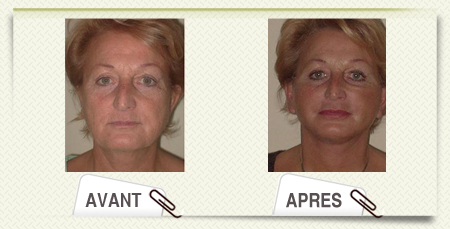 lifting visage avant après